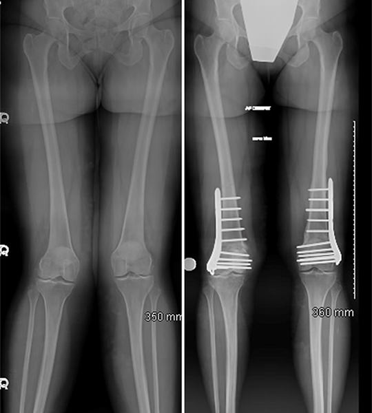 X-ray visuals of deformity correction