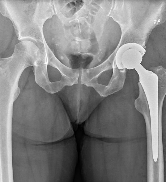 Hip replacement x-ray illustration
