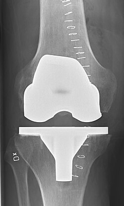 Joint replacement iLlustration.