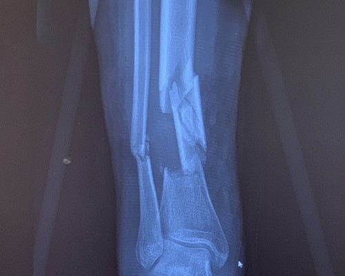Complex Fracture Treatment at Indore by Dr. Shubham Thori