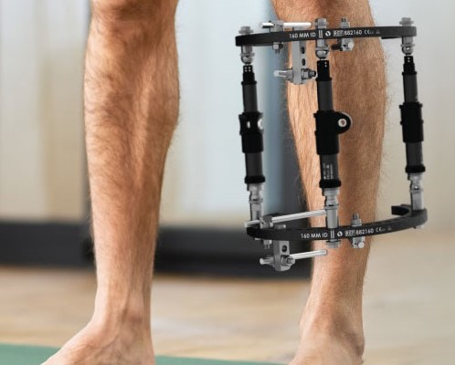 Deformity Correction Treatment at Indore by Dr. Shubham Thori