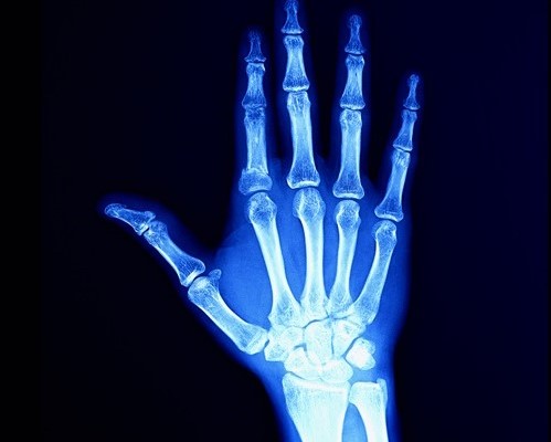 Best Arthritis Treatment at Indore by Dr. Shubham Thori